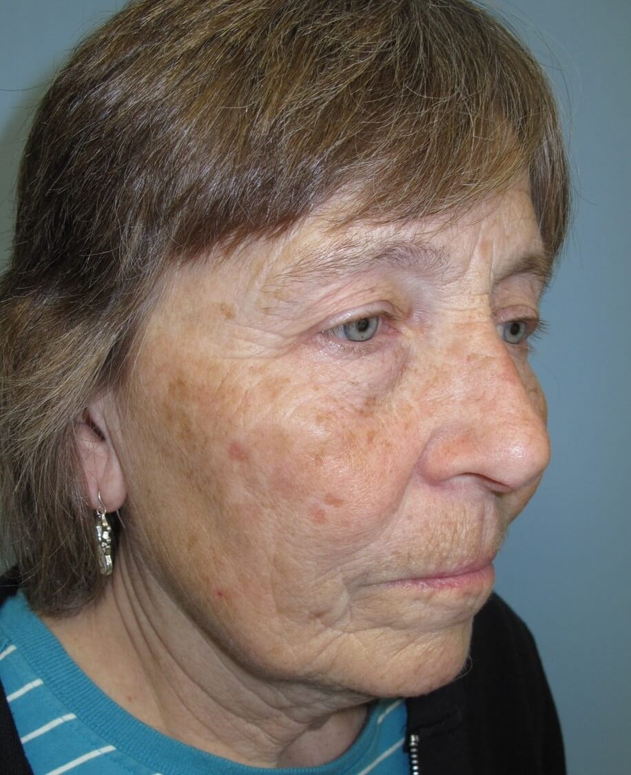 Blepharoplasty Before