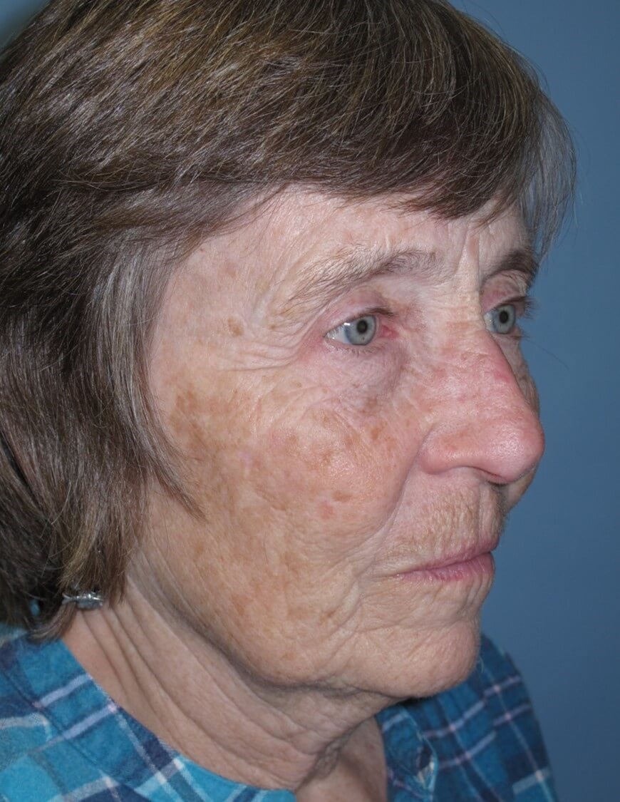 Blepharoplasty After