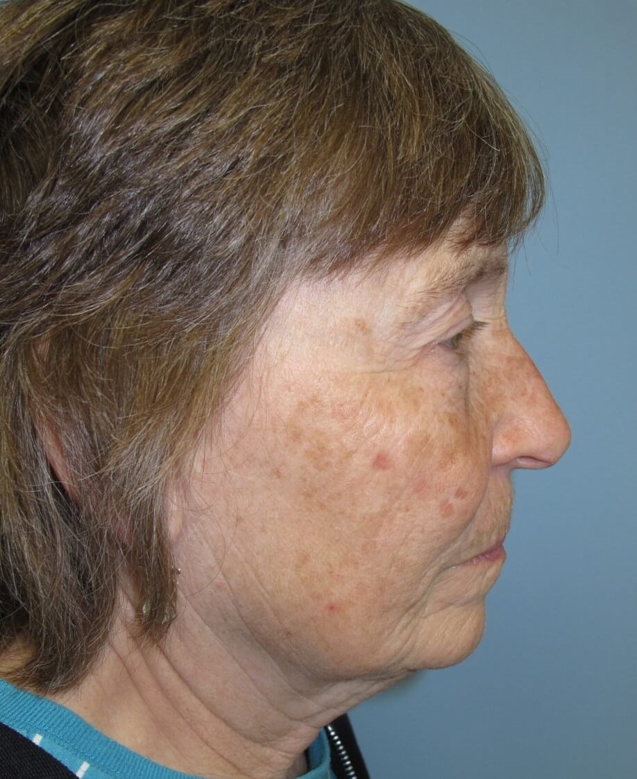 Blepharoplasty Before