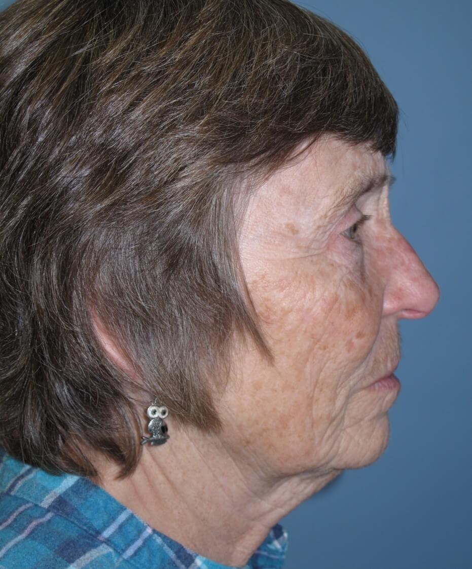 Blepharoplasty After