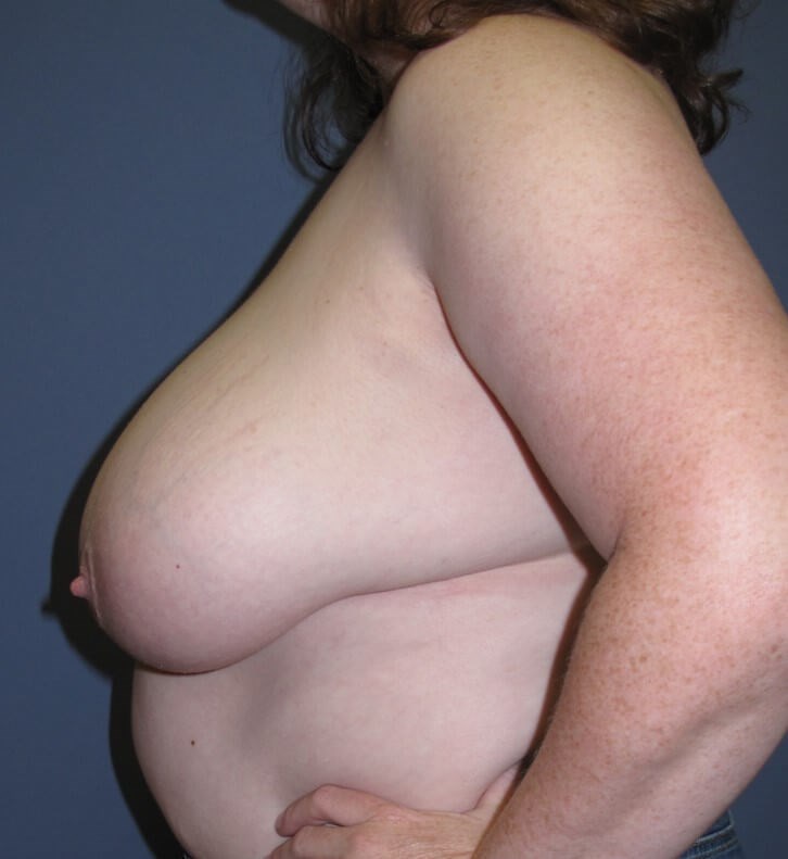 Breast Reduction Before