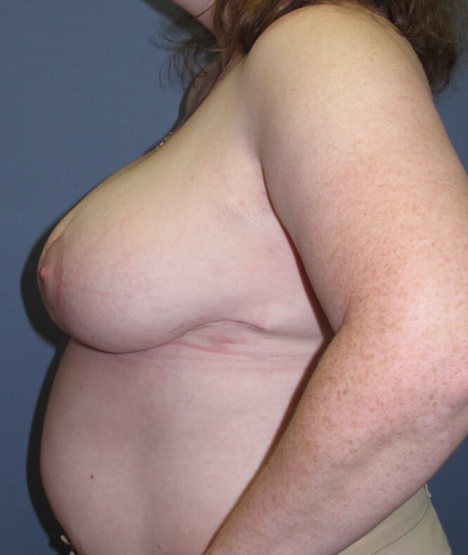 Breast Reduction After