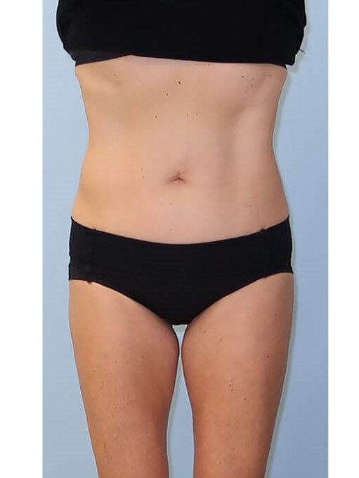 UltraShape Power/VelaShapeIII After
