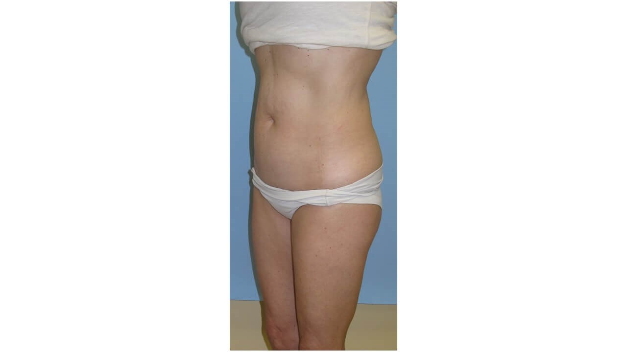 UltraShape Power/VelaShapeIII Before