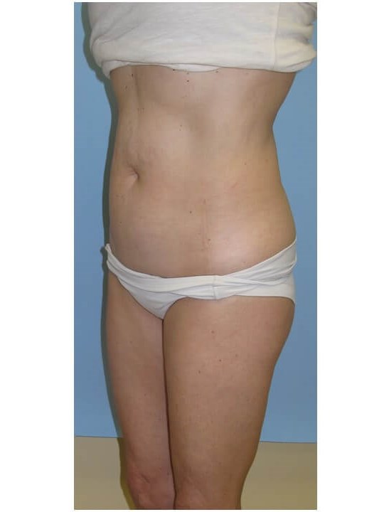 UltraShape Power/VelaShapeIII Before