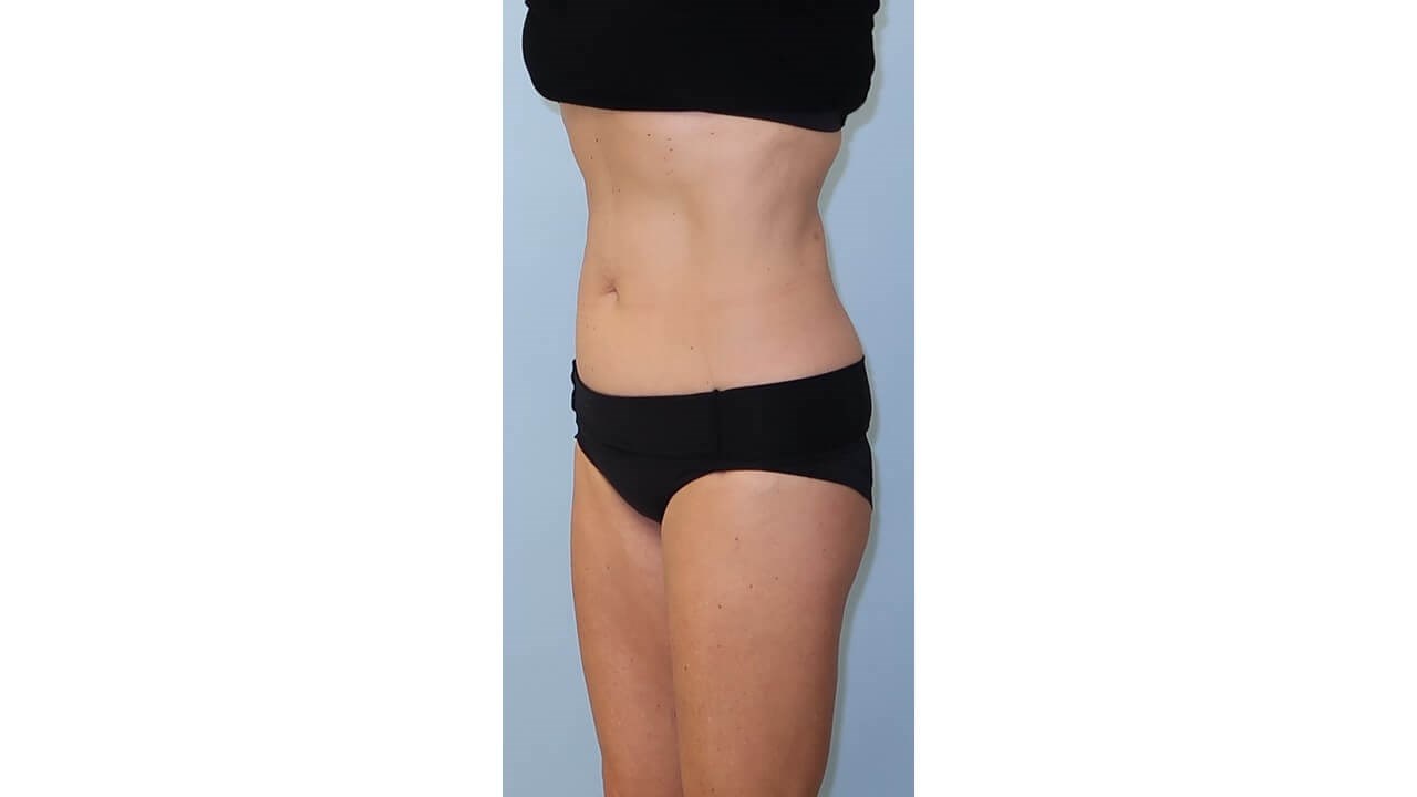 UltraShape Power/VelaShapeIII After