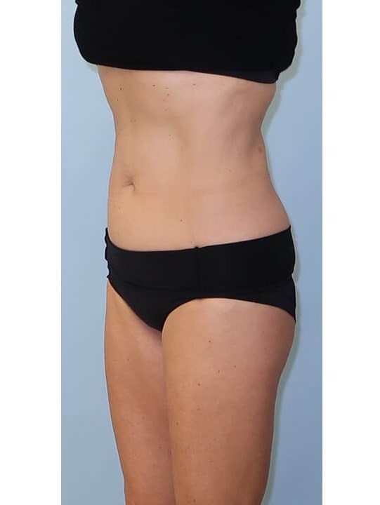 UltraShape Power/VelaShapeIII After