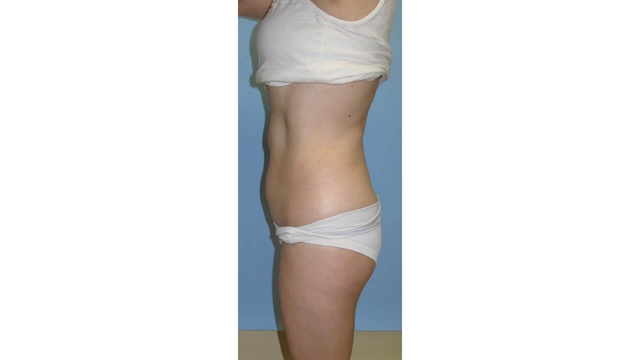 UltraShape Power/VelaShapeIII Before