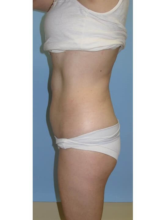 UltraShape Power/VelaShapeIII Before