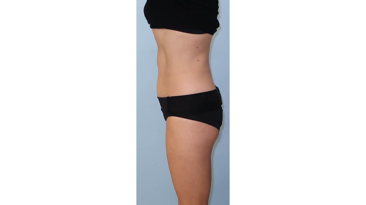 UltraShape Power/VelaShapeIII After