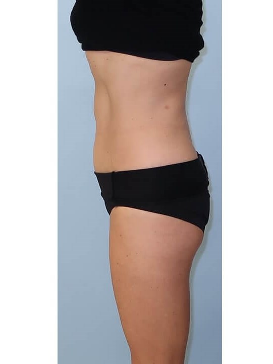 UltraShape Power/VelaShapeIII After