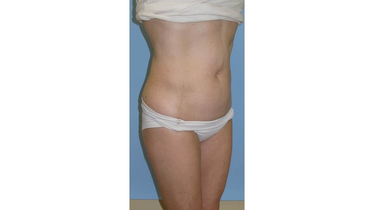 UltraShape Power/VelaShapeIII Before