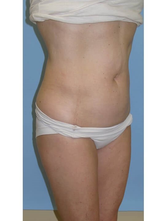 UltraShape Power/VelaShapeIII Before