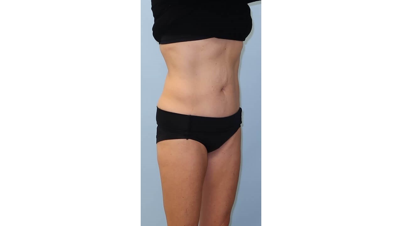 UltraShape Power/VelaShapeIII After