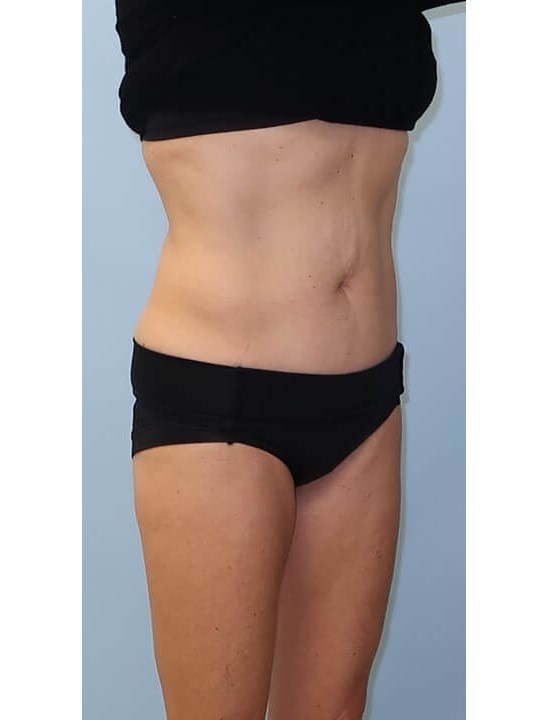UltraShape Power/VelaShapeIII After