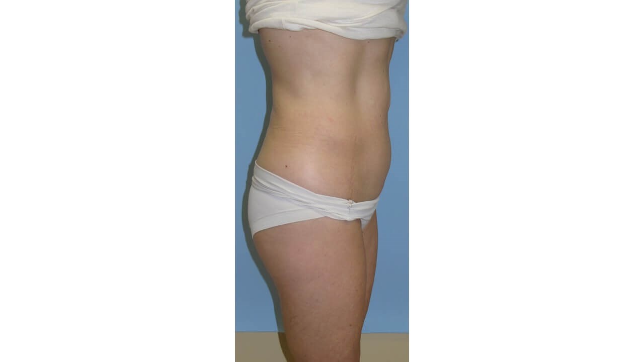 UltraShape Power/VelaShapeIII Before