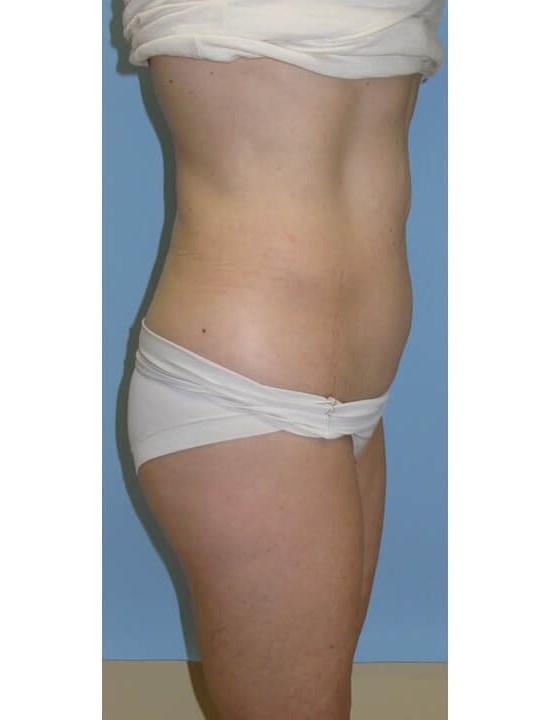 UltraShape Power/VelaShapeIII Before