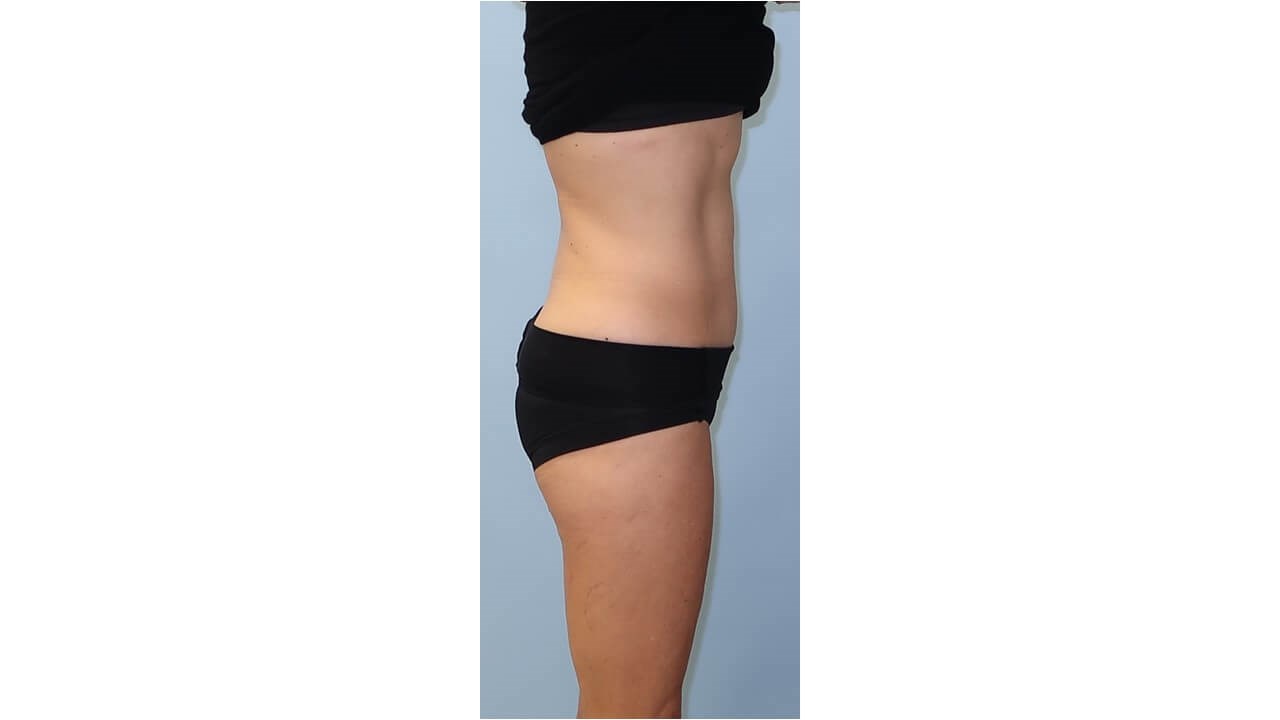 UltraShape Power/VelaShapeIII After