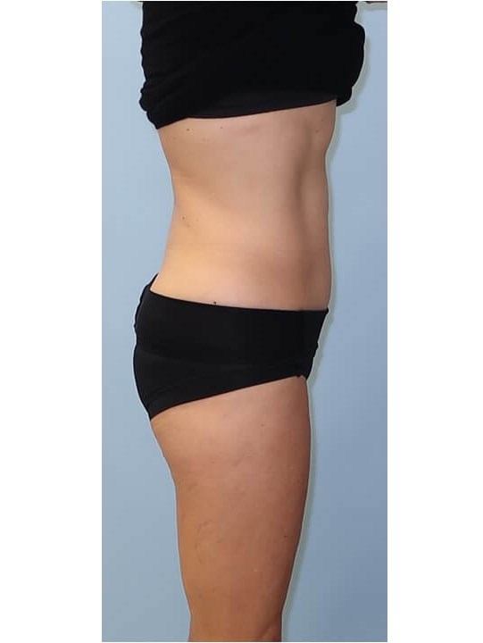 UltraShape Power/VelaShapeIII After