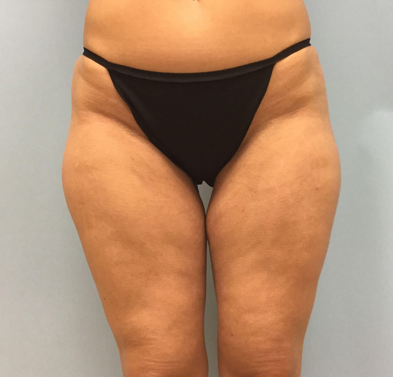 velashape 3 cellulite