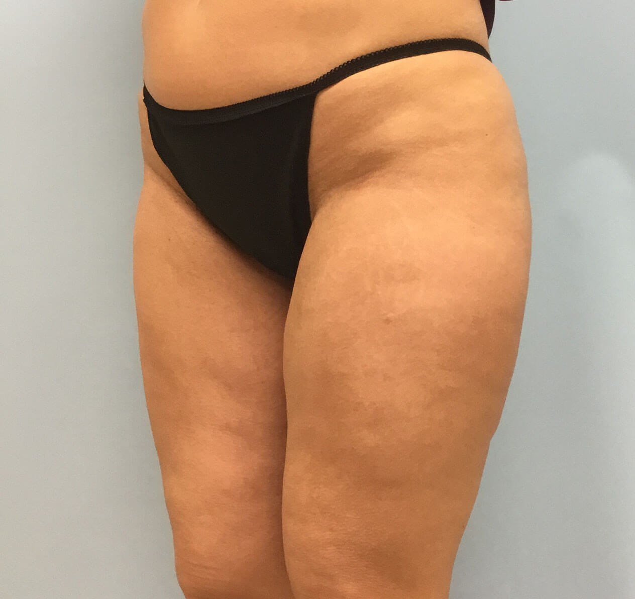 VelaShape III for Cellulite Before