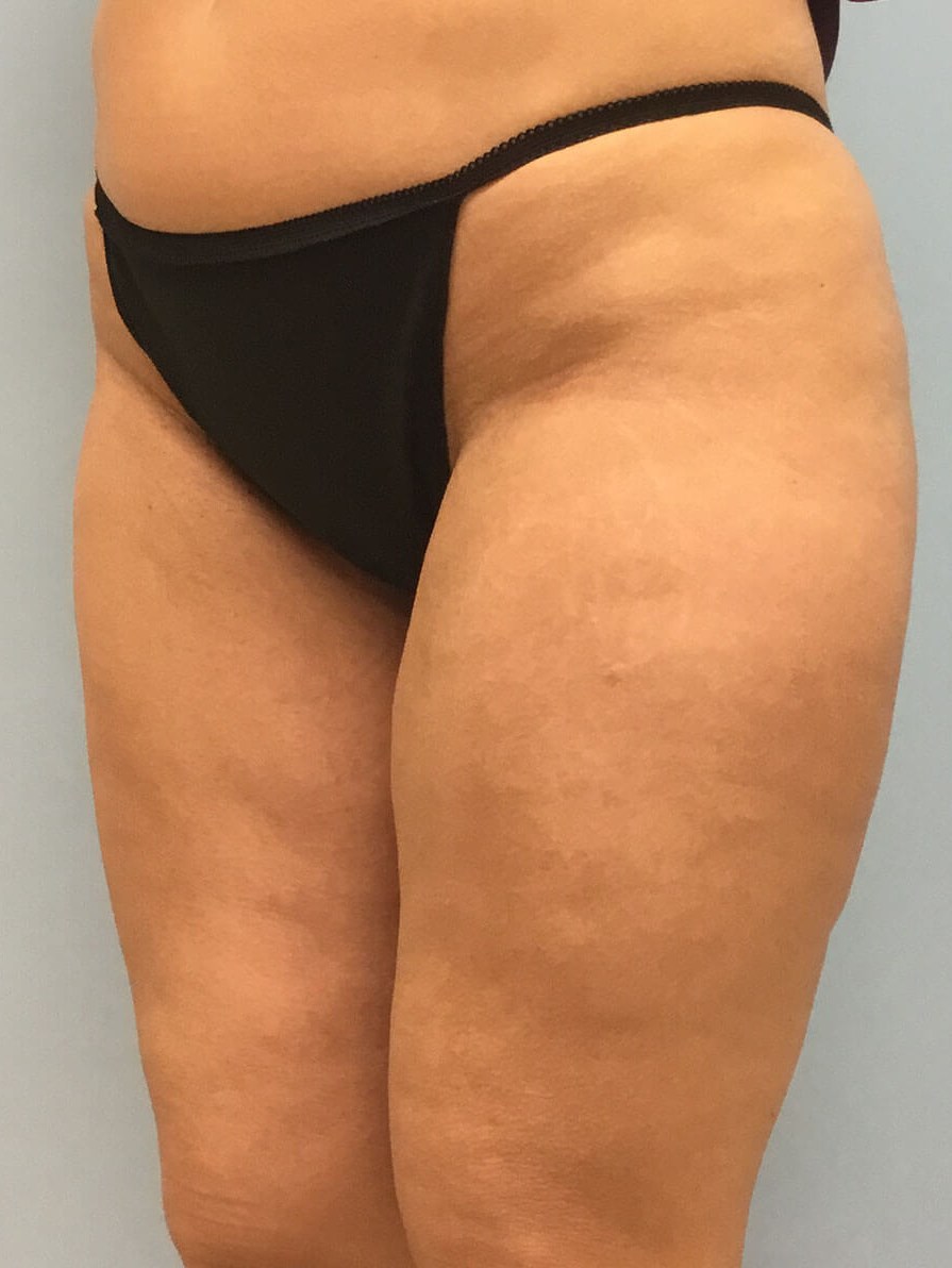 VelaShape III for Cellulite Before