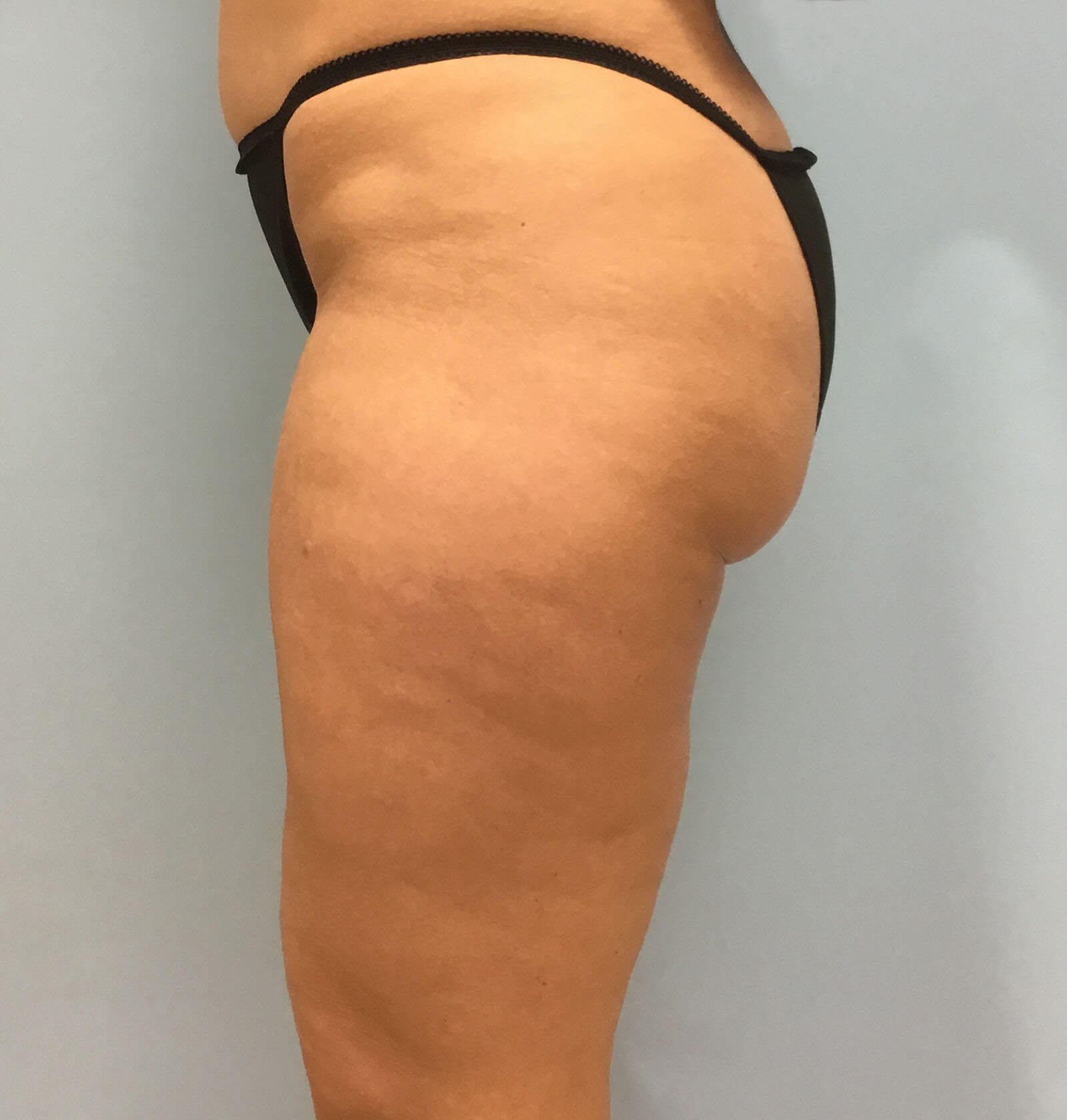 VelaShape III for Cellulite Before