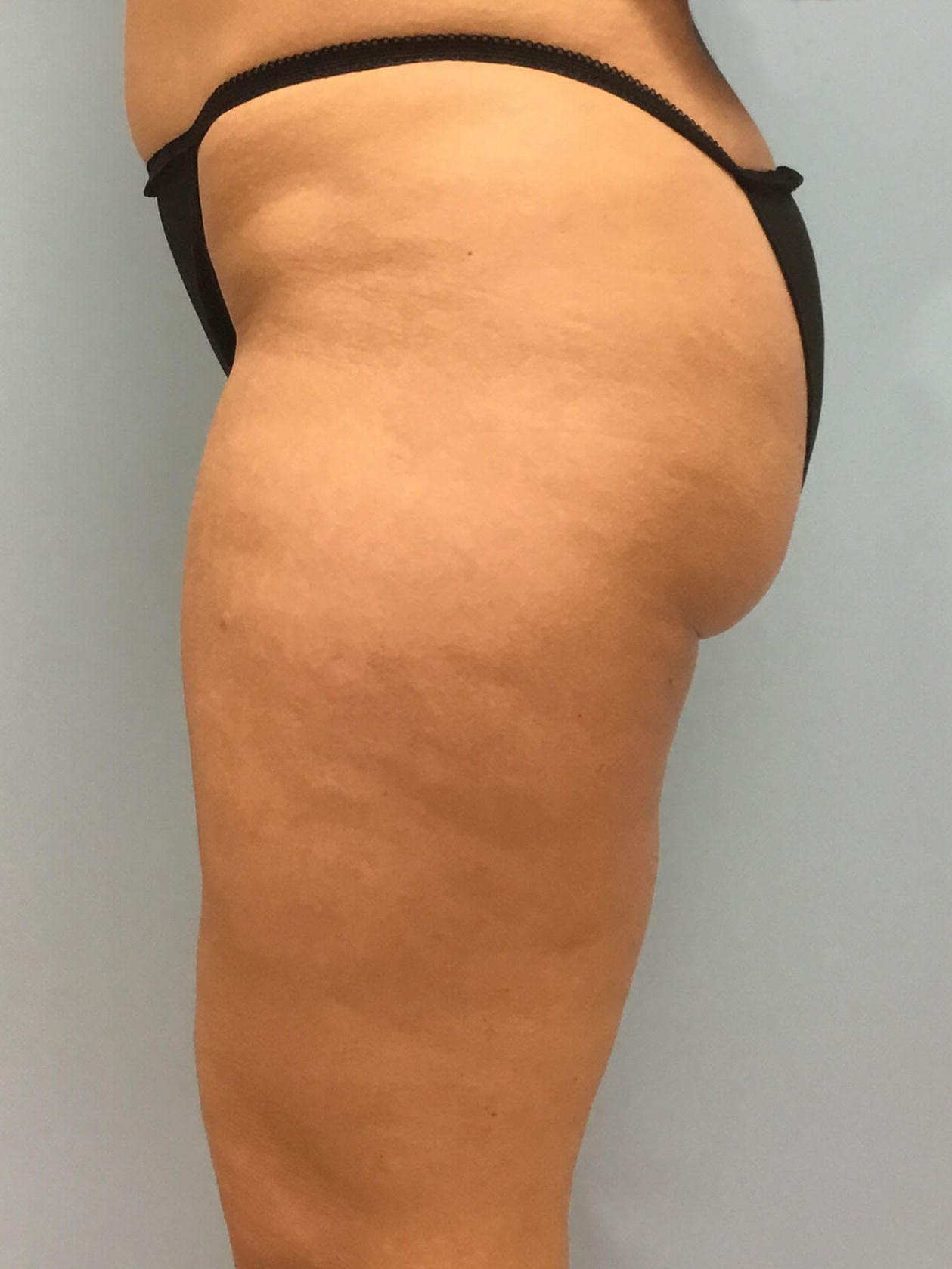 VelaShape III for Cellulite Before