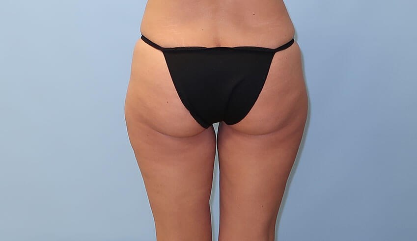VelaShape III for Cellulite After