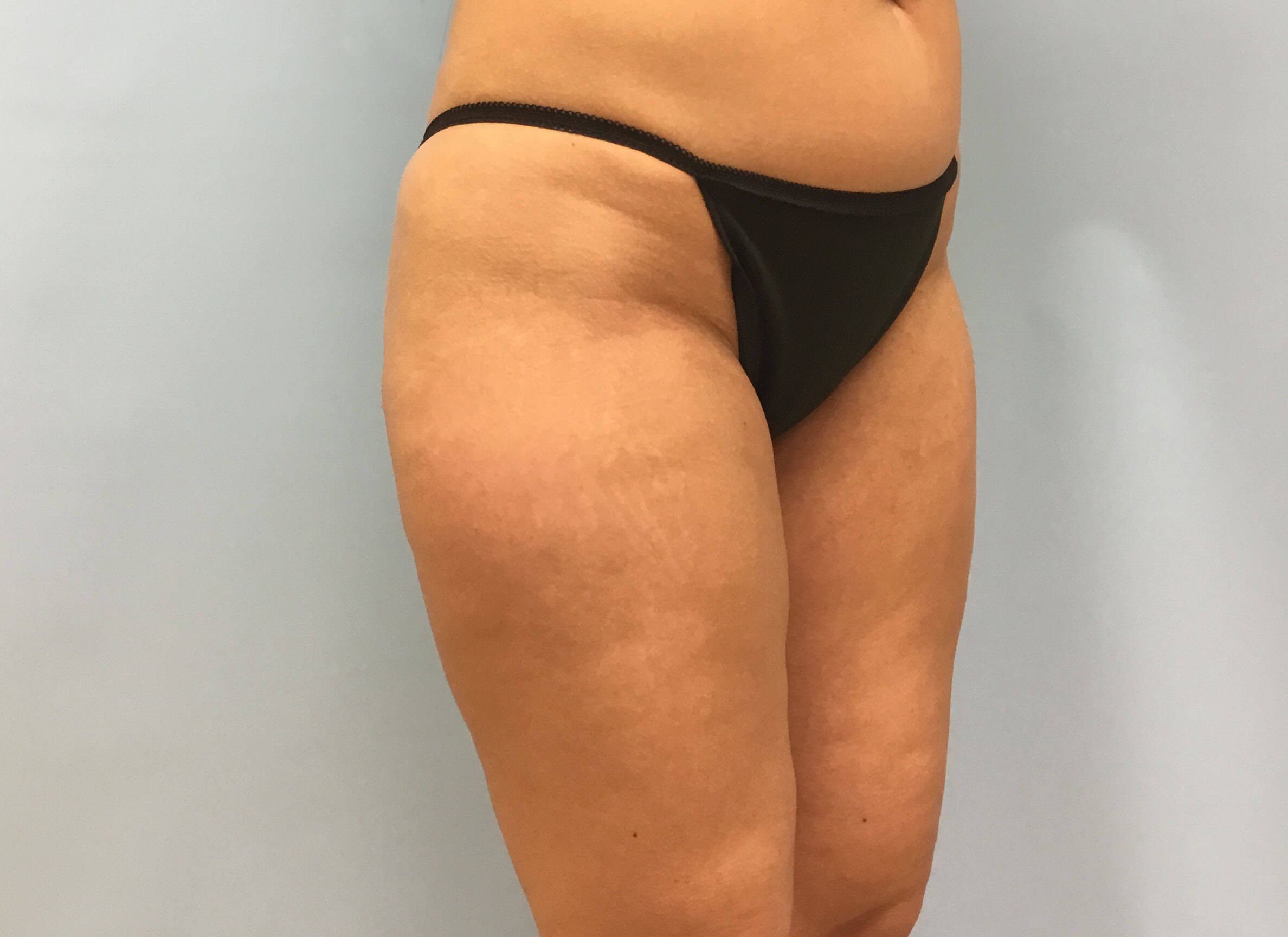 VelaShape III for Cellulite Before