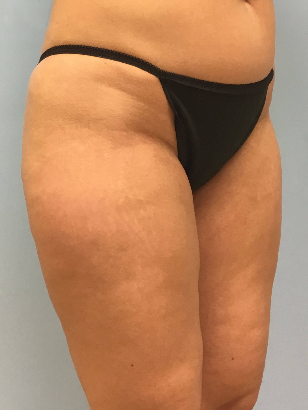 VelaShape III for Cellulite Before
