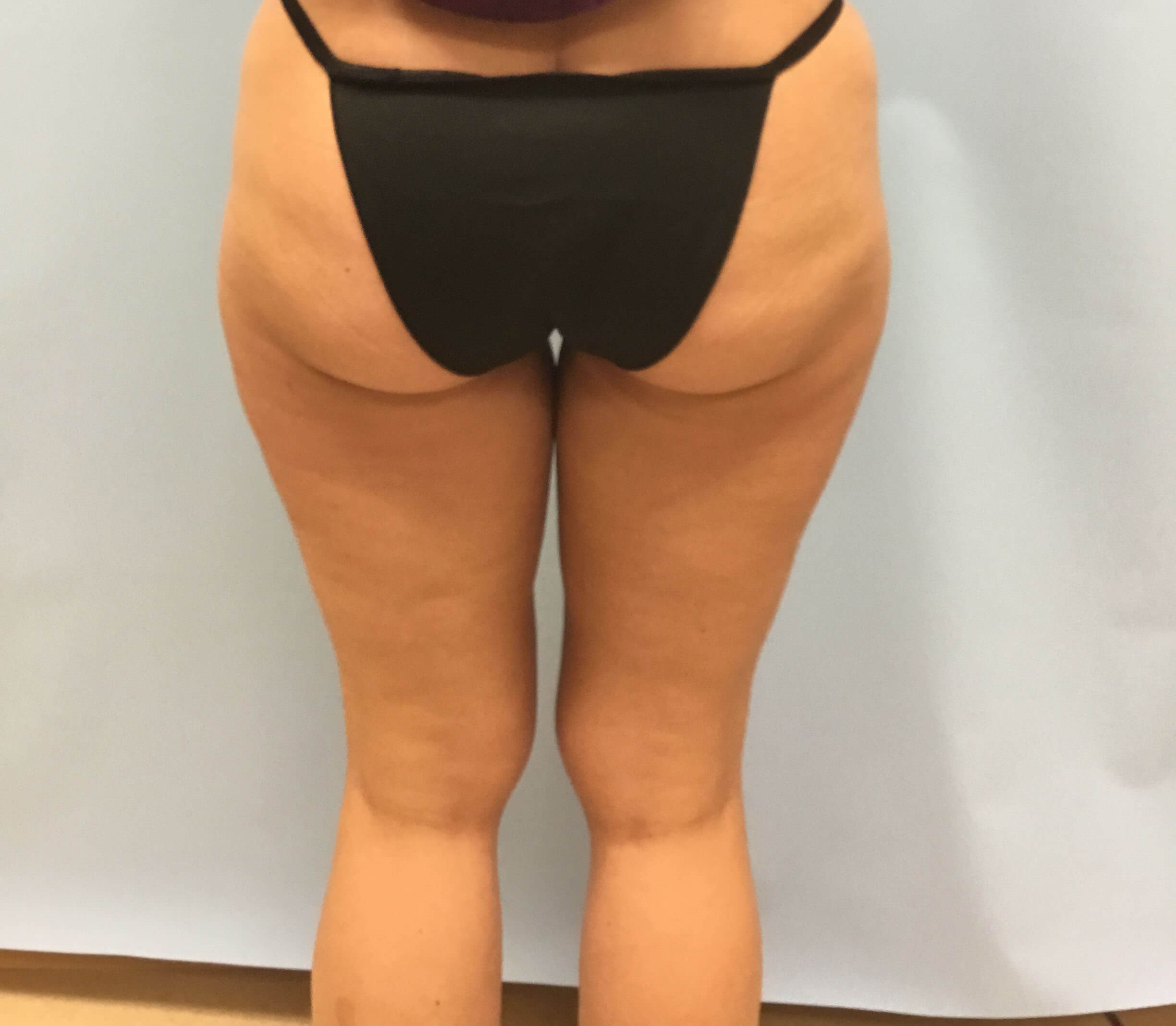 VelaShape III for Cellulite Before
