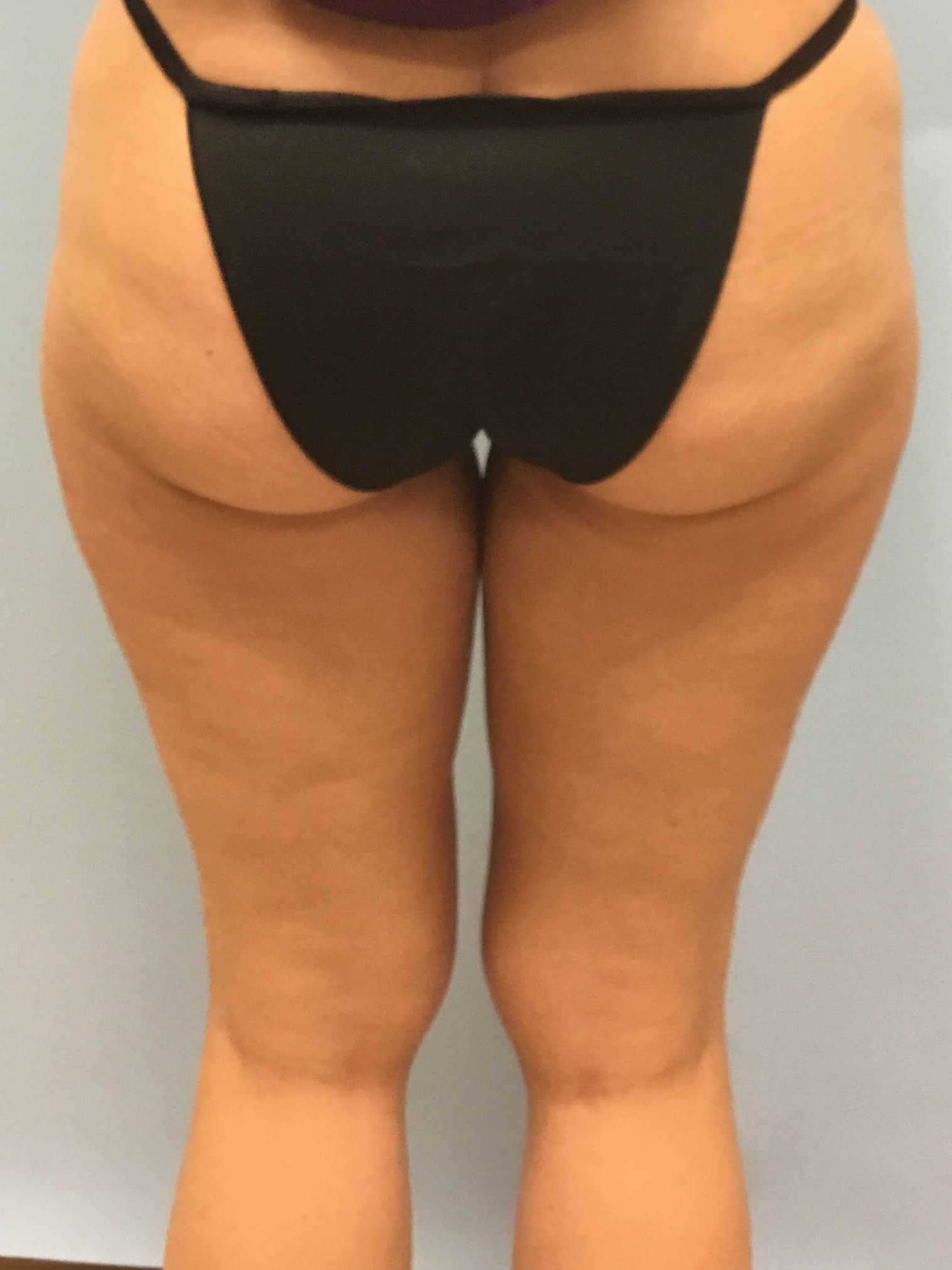 VelaShape III for Cellulite Before