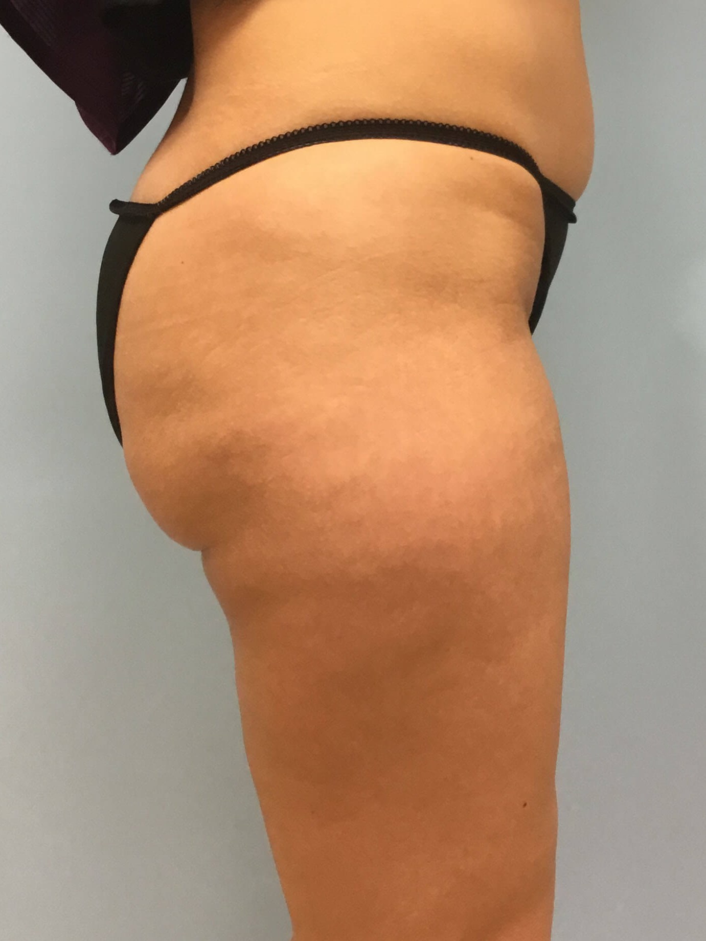 VelaShape III for Cellulite Before