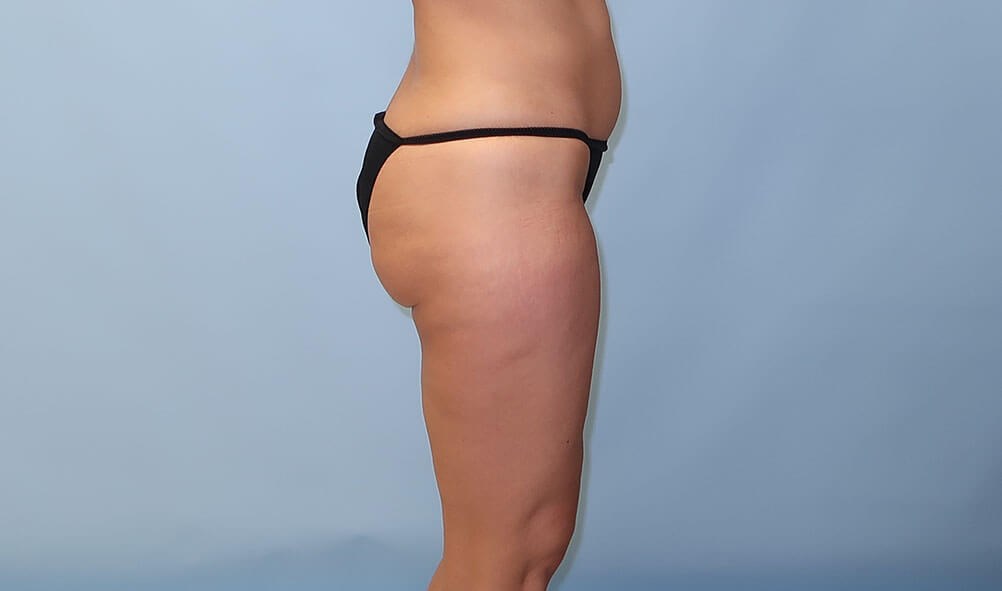 VelaShape III for Cellulite After
