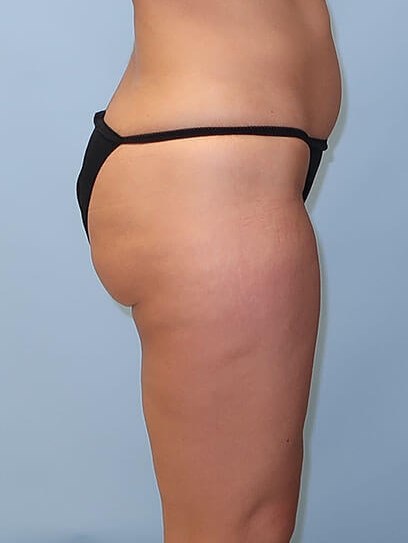 VelaShape III for Cellulite After