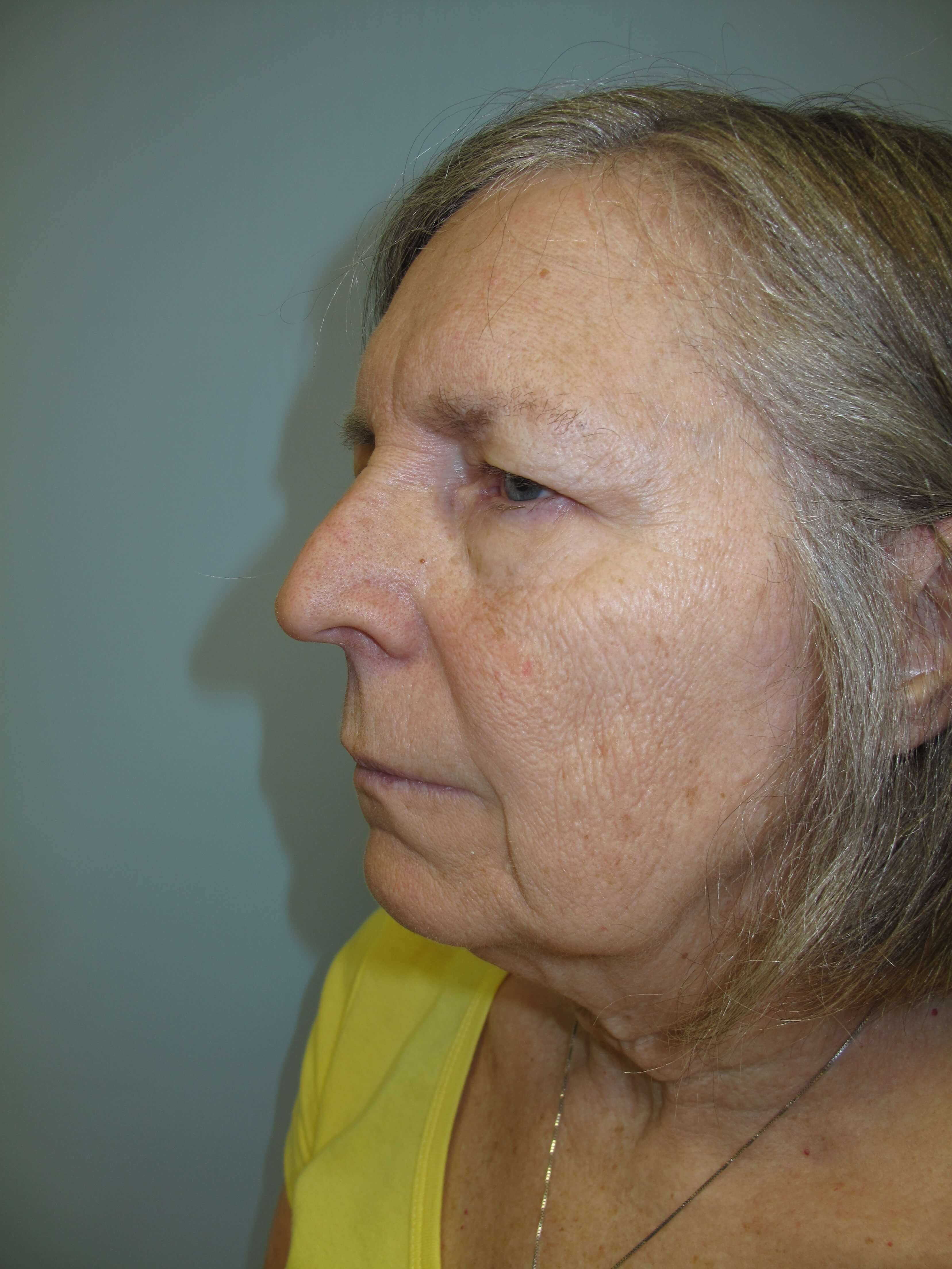 Upper eyelid blepharoplasty Before