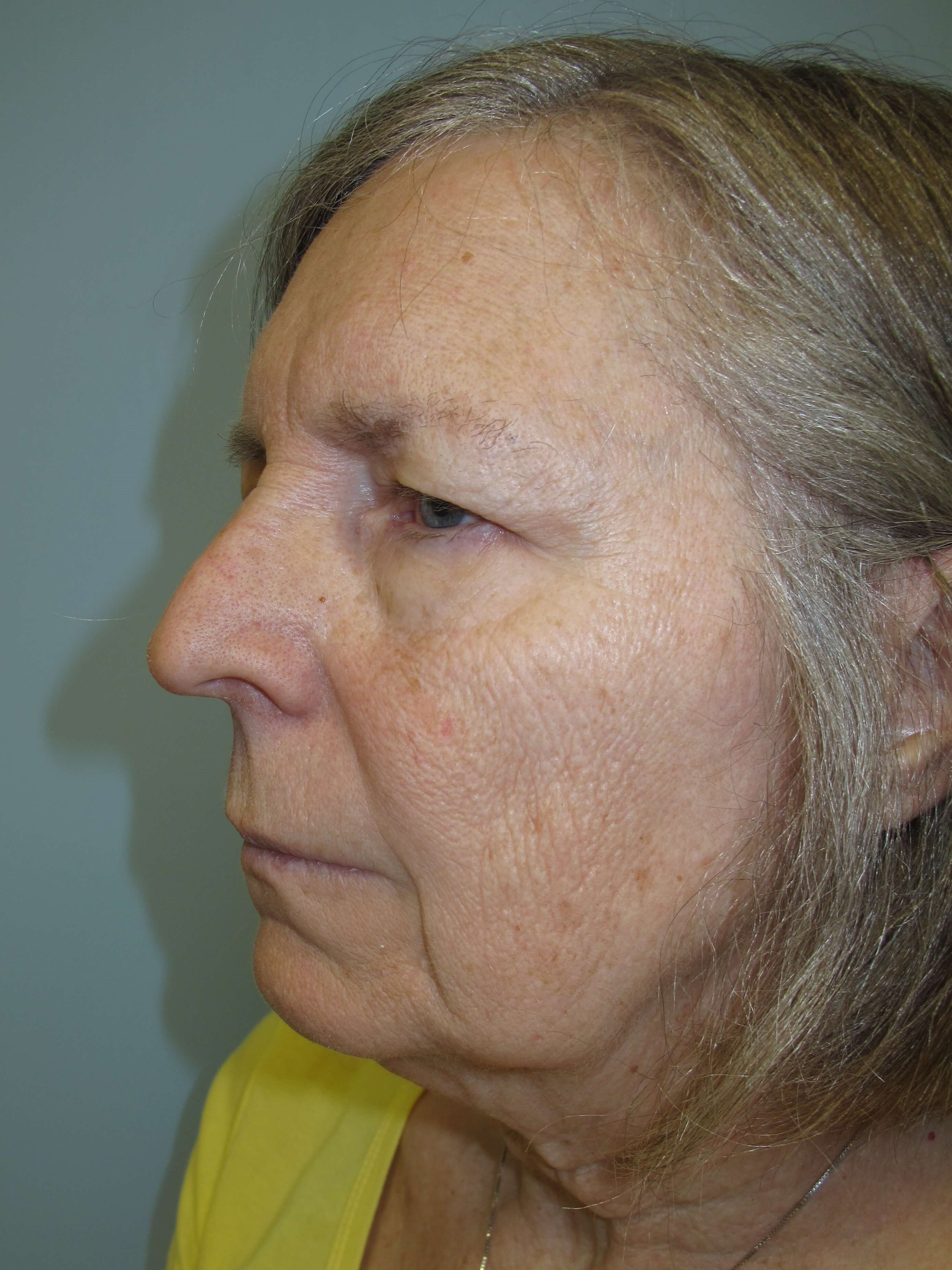 Upper eyelid blepharoplasty Before