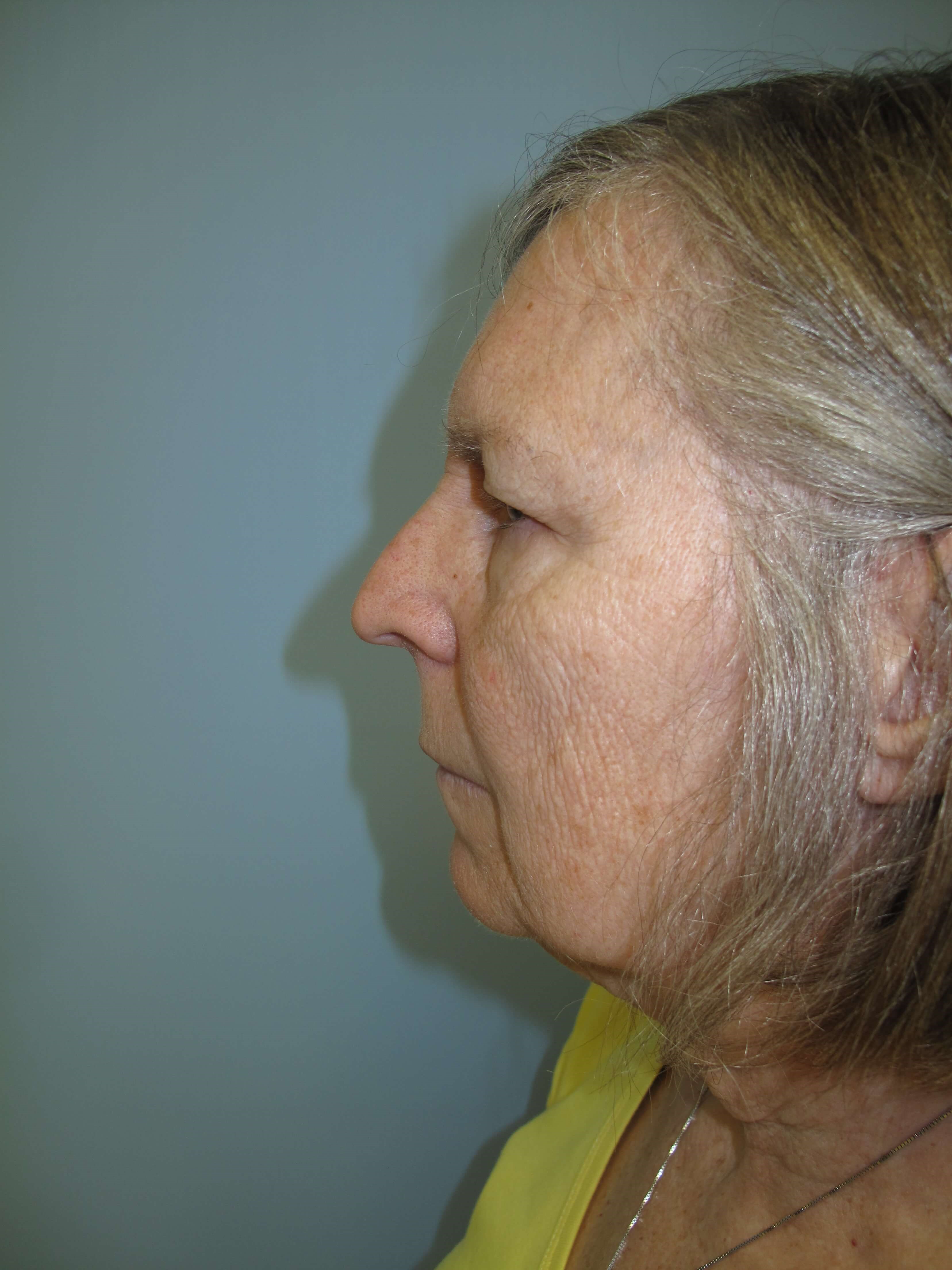 Upper eyelid blepharoplasty Before