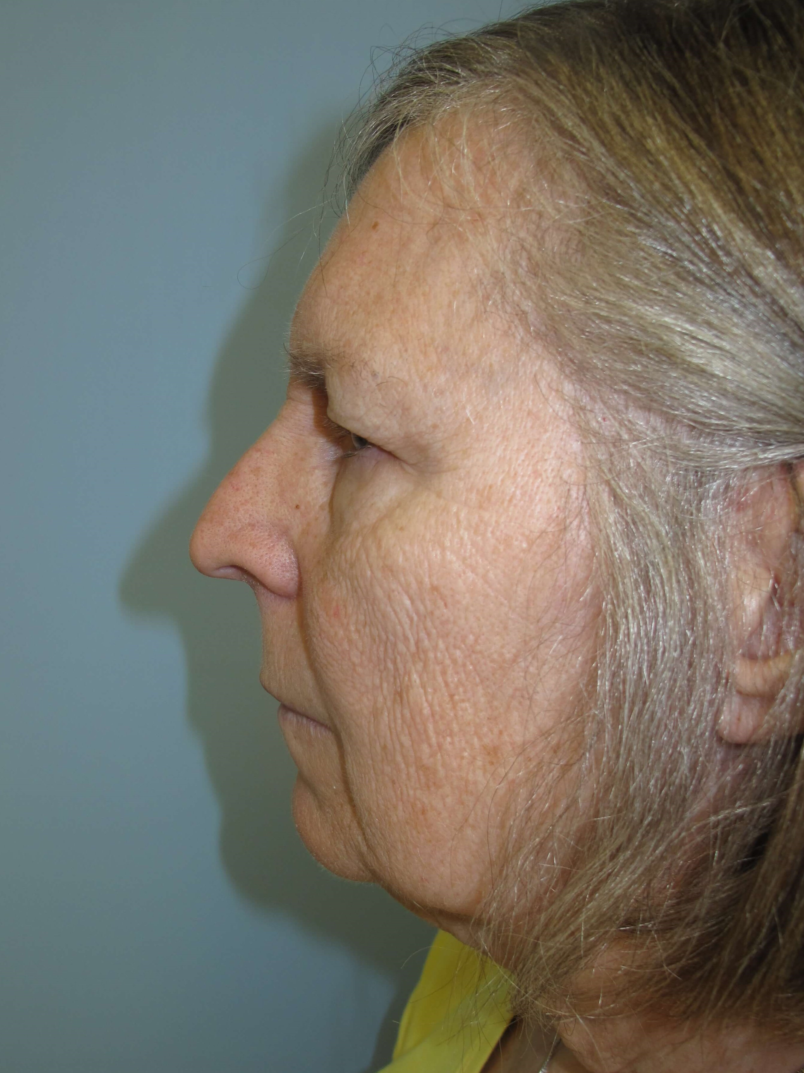 Upper eyelid blepharoplasty Before