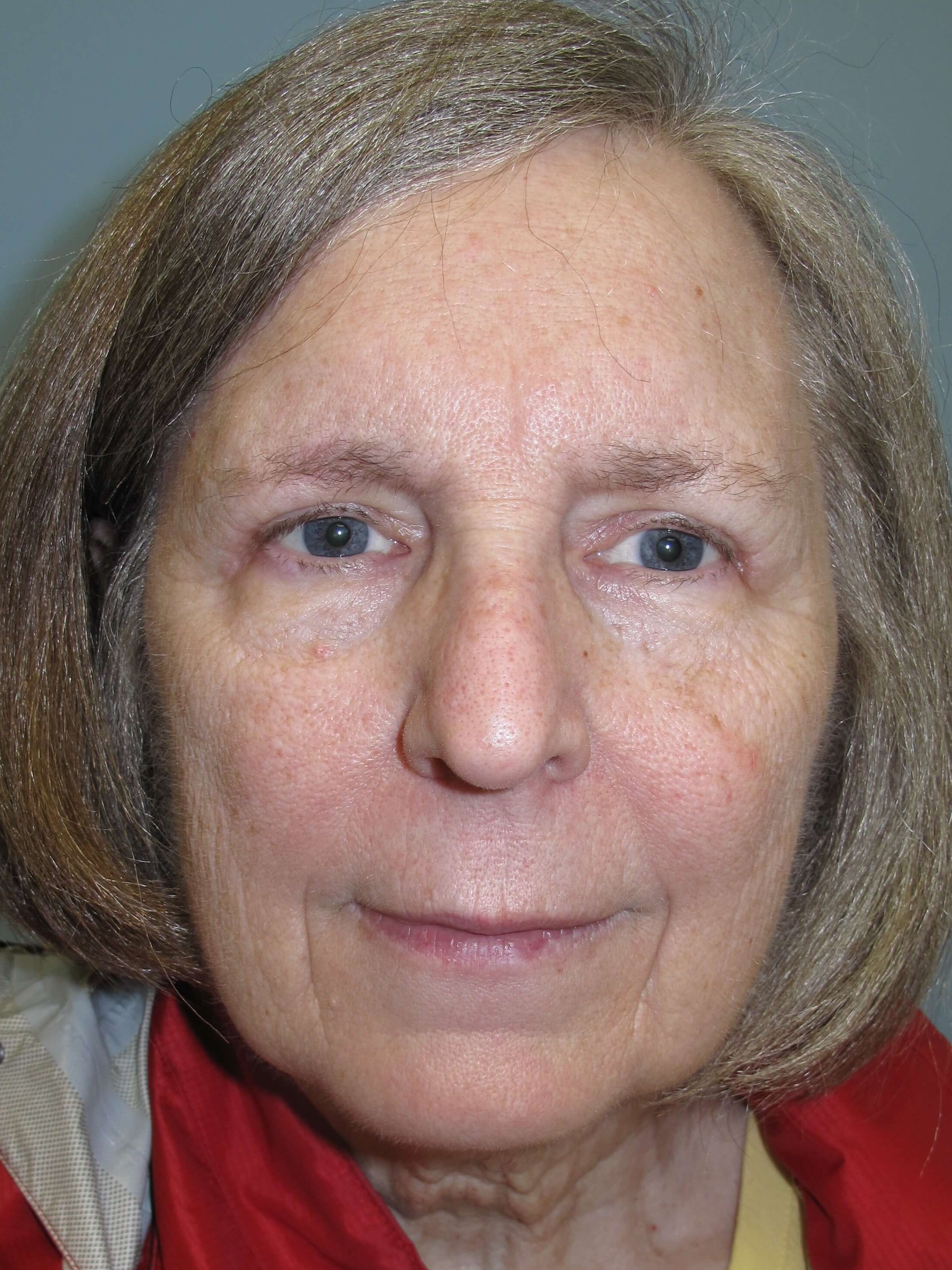Upper eyelid blepharoplasty After