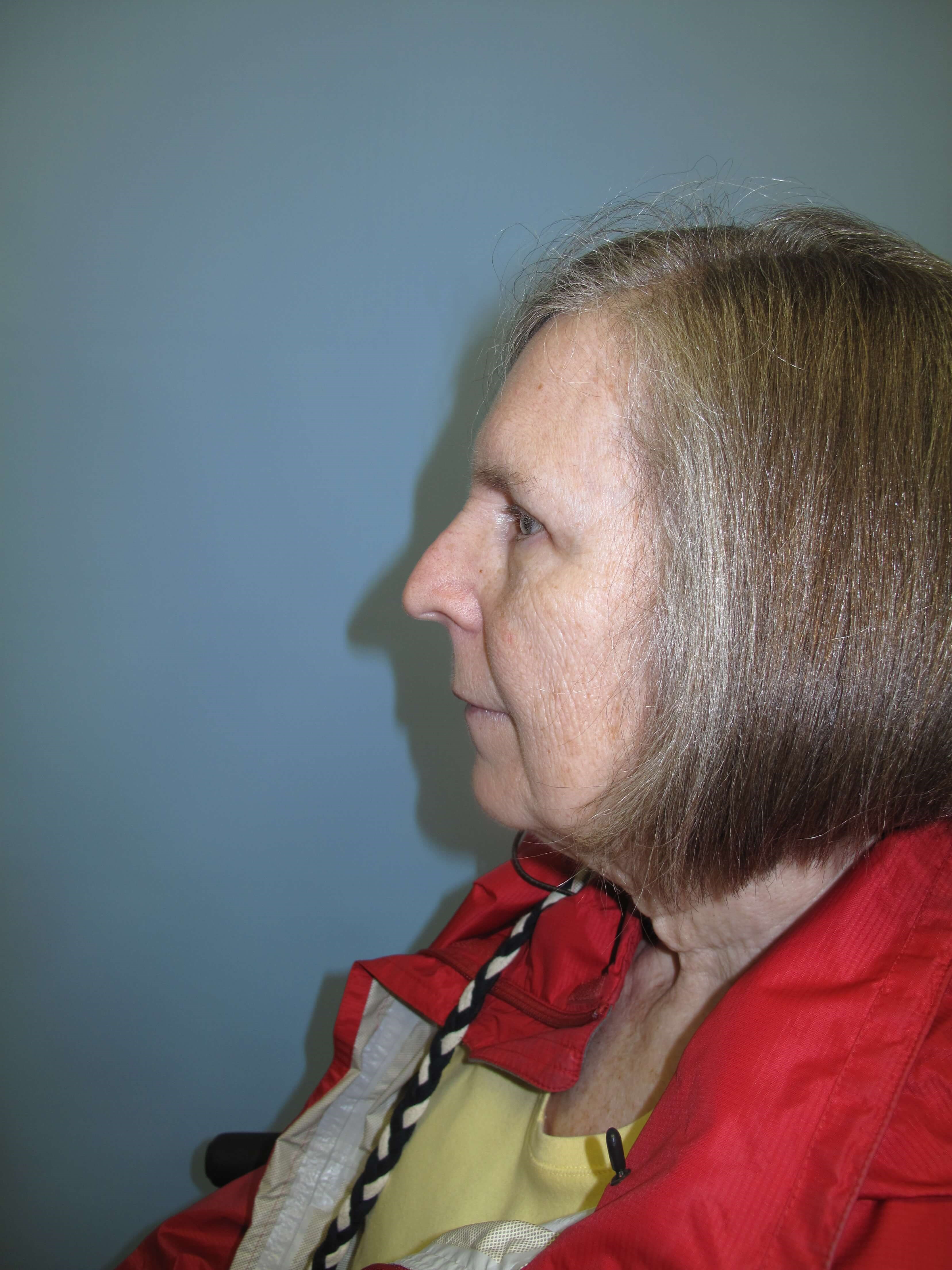 Upper eyelid blepharoplasty After
