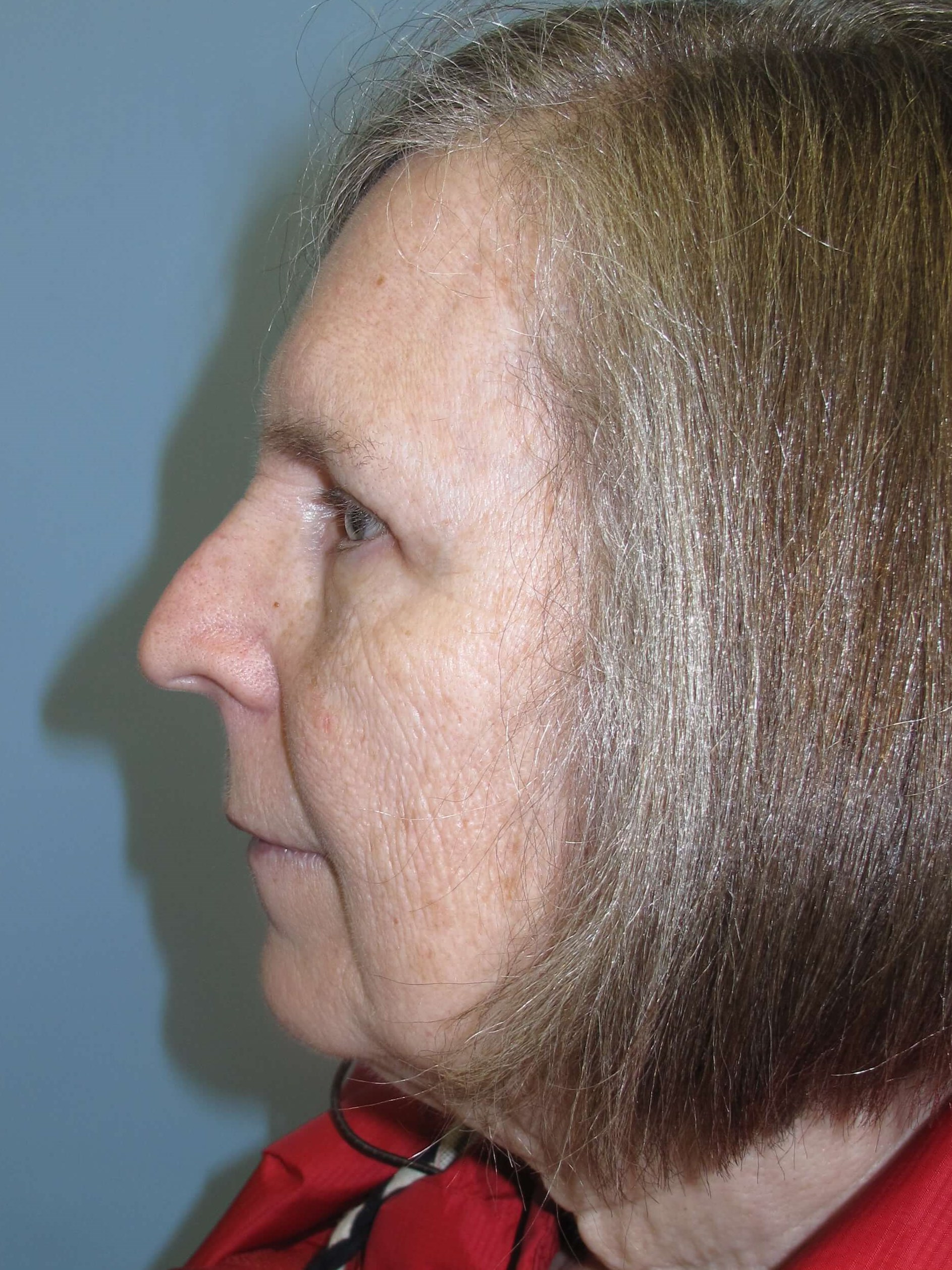 Upper eyelid blepharoplasty After