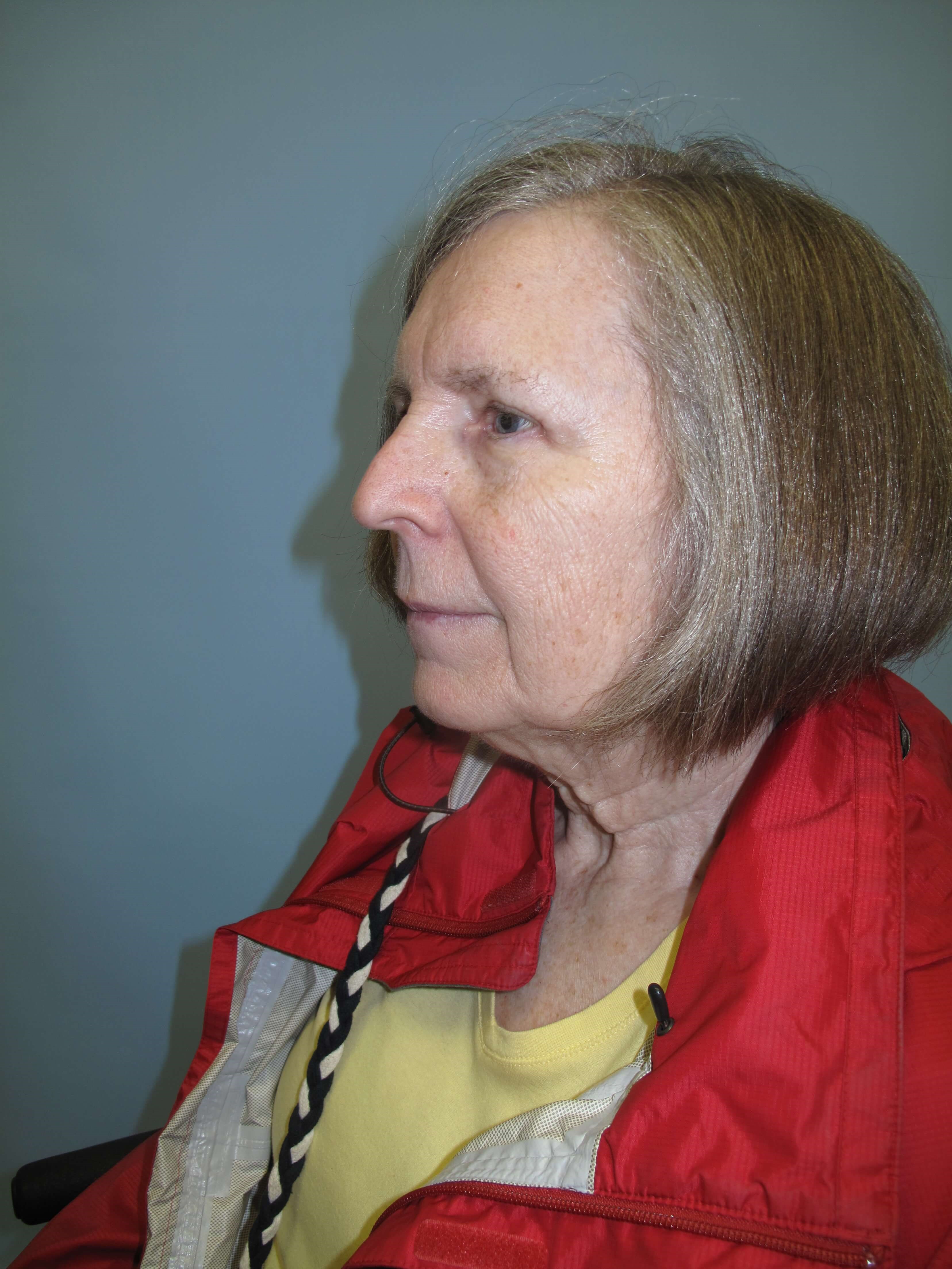 Upper eyelid blepharoplasty After