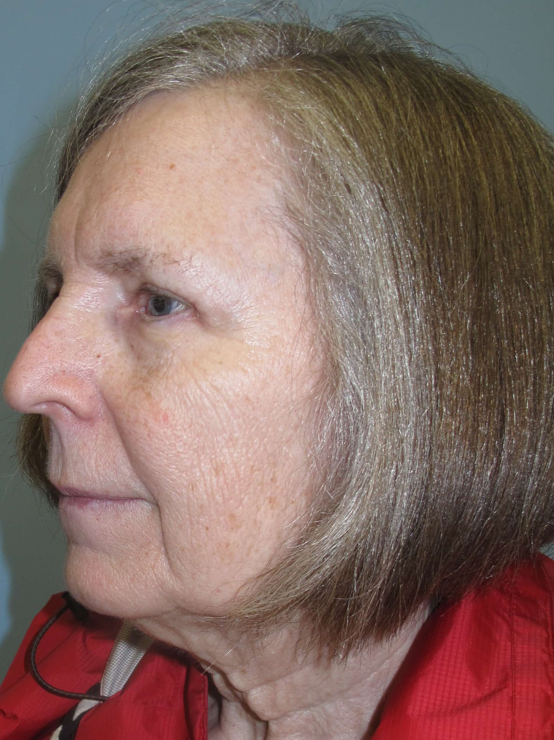 Upper eyelid blepharoplasty After
