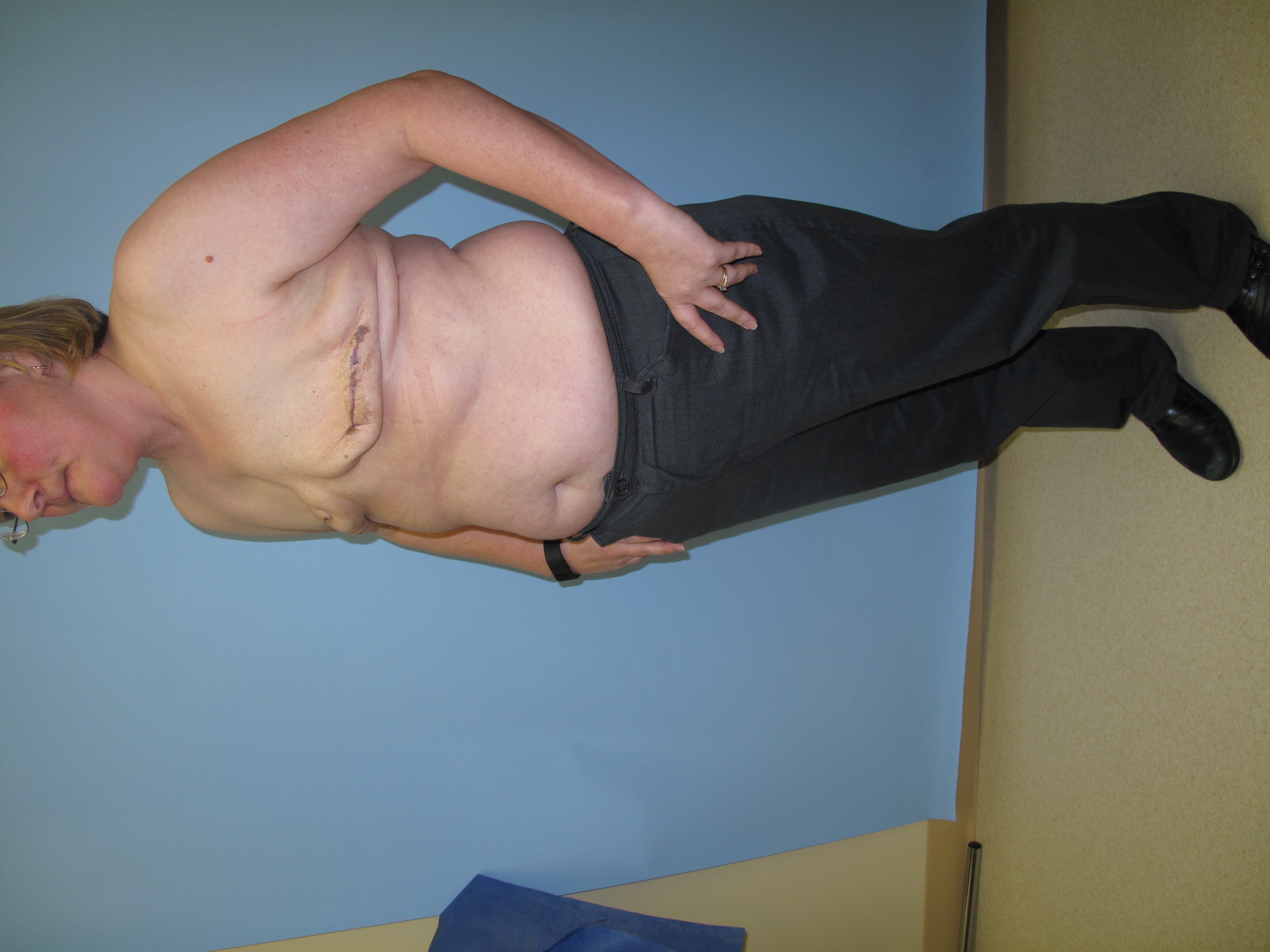 Breast Reconstruction Before
