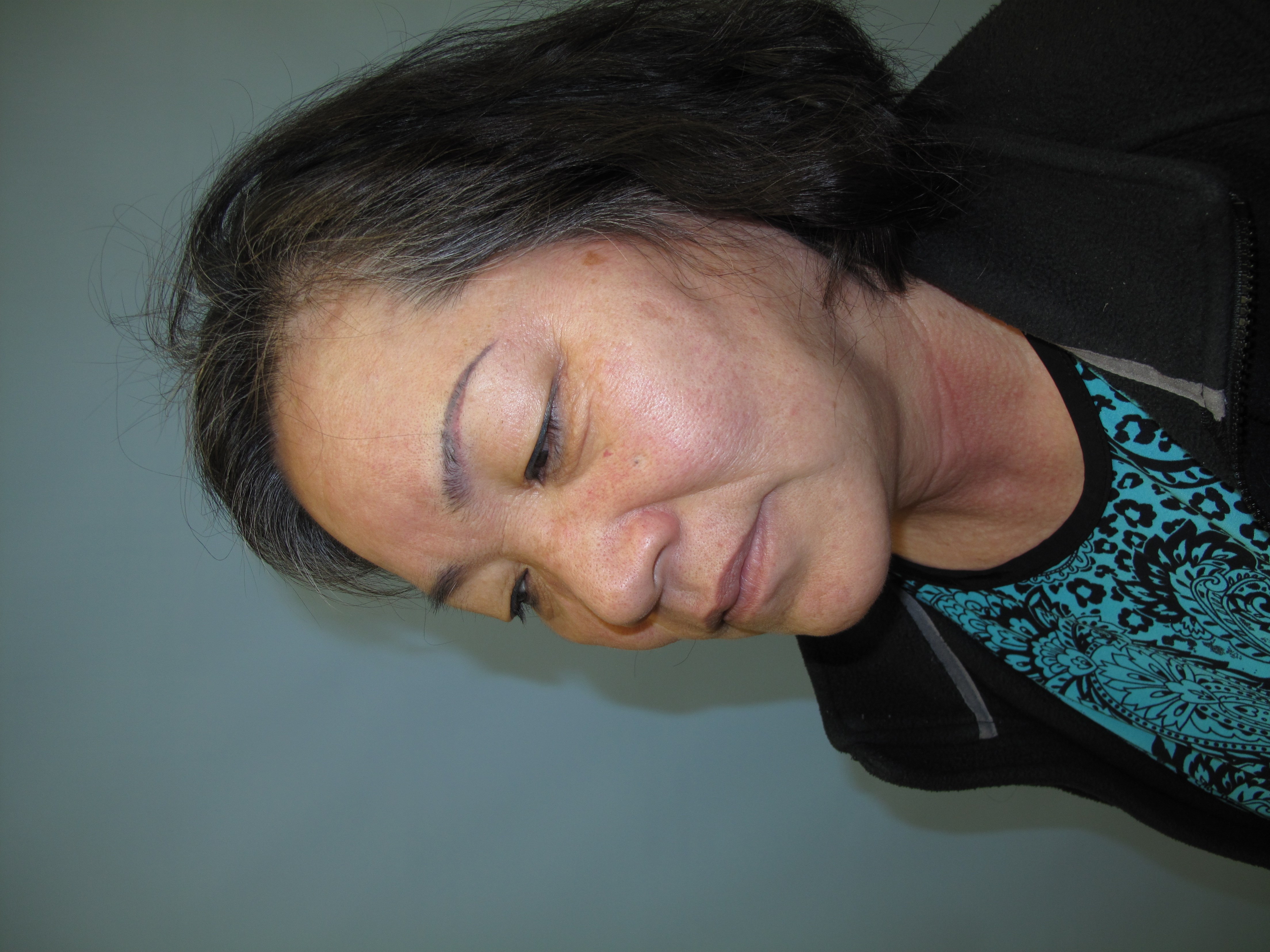 East Asian blepharoplasty Before