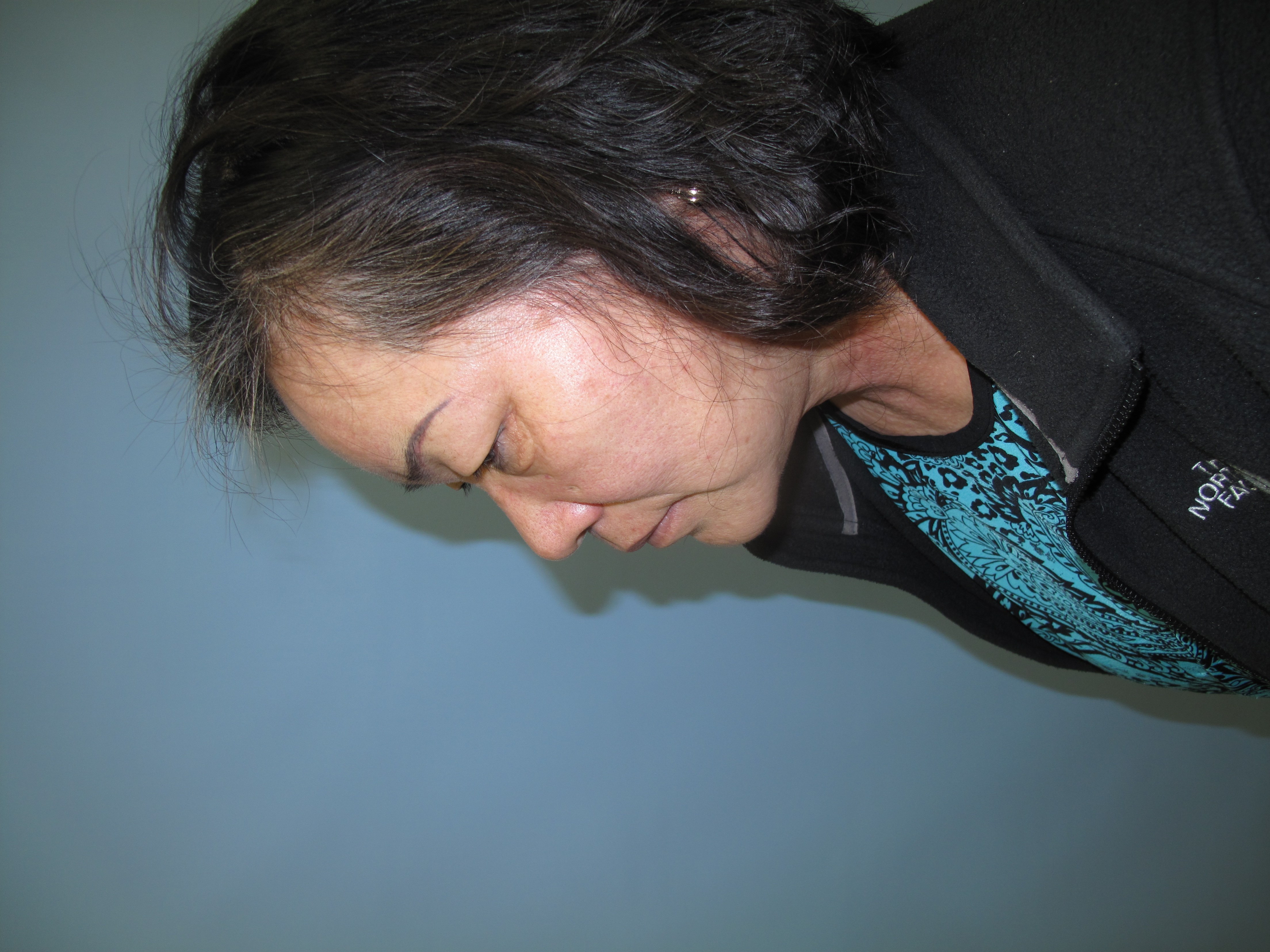 East Asian blepharoplasty Before