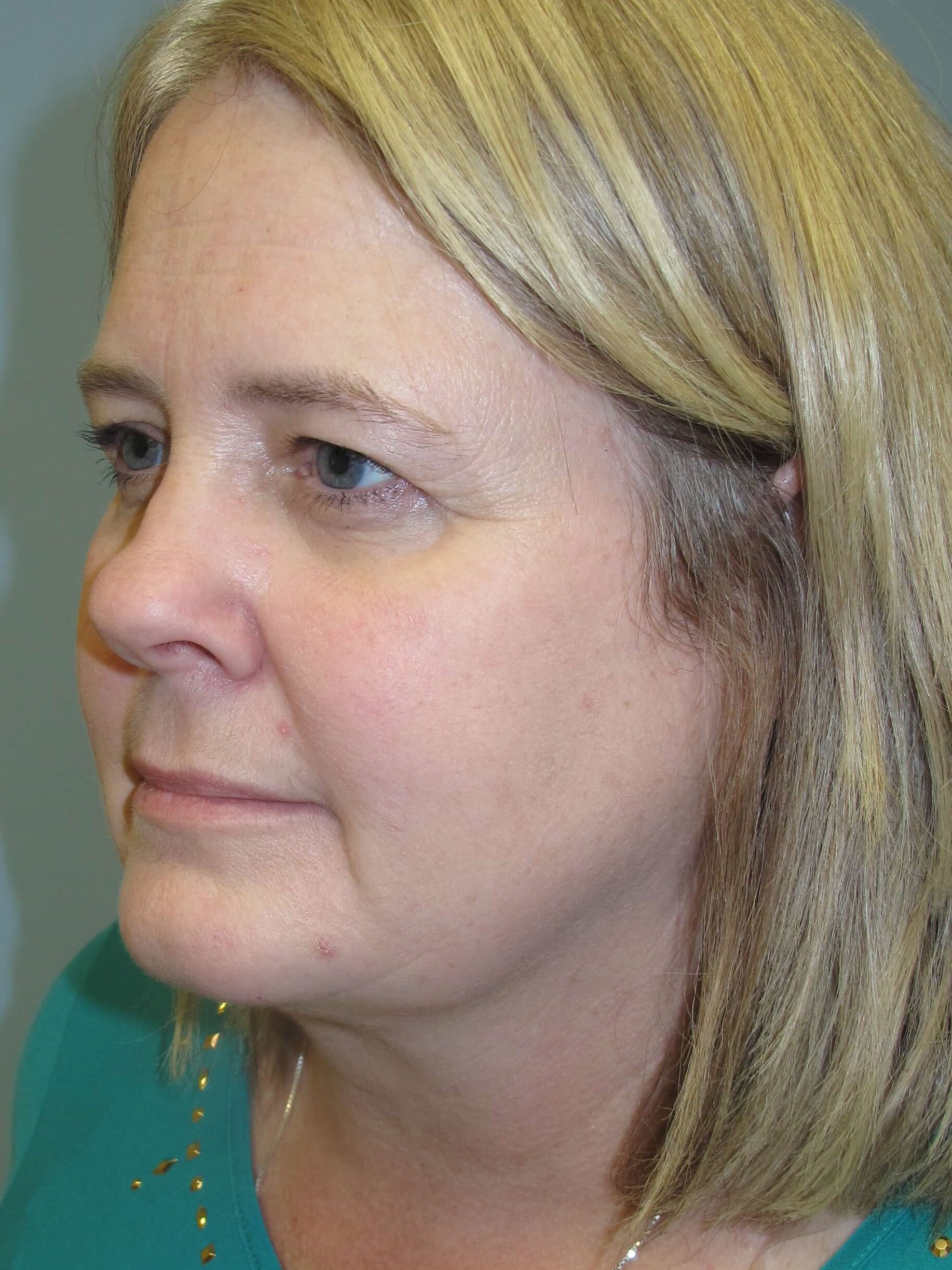 Upper eyelid blepharoplasty Before