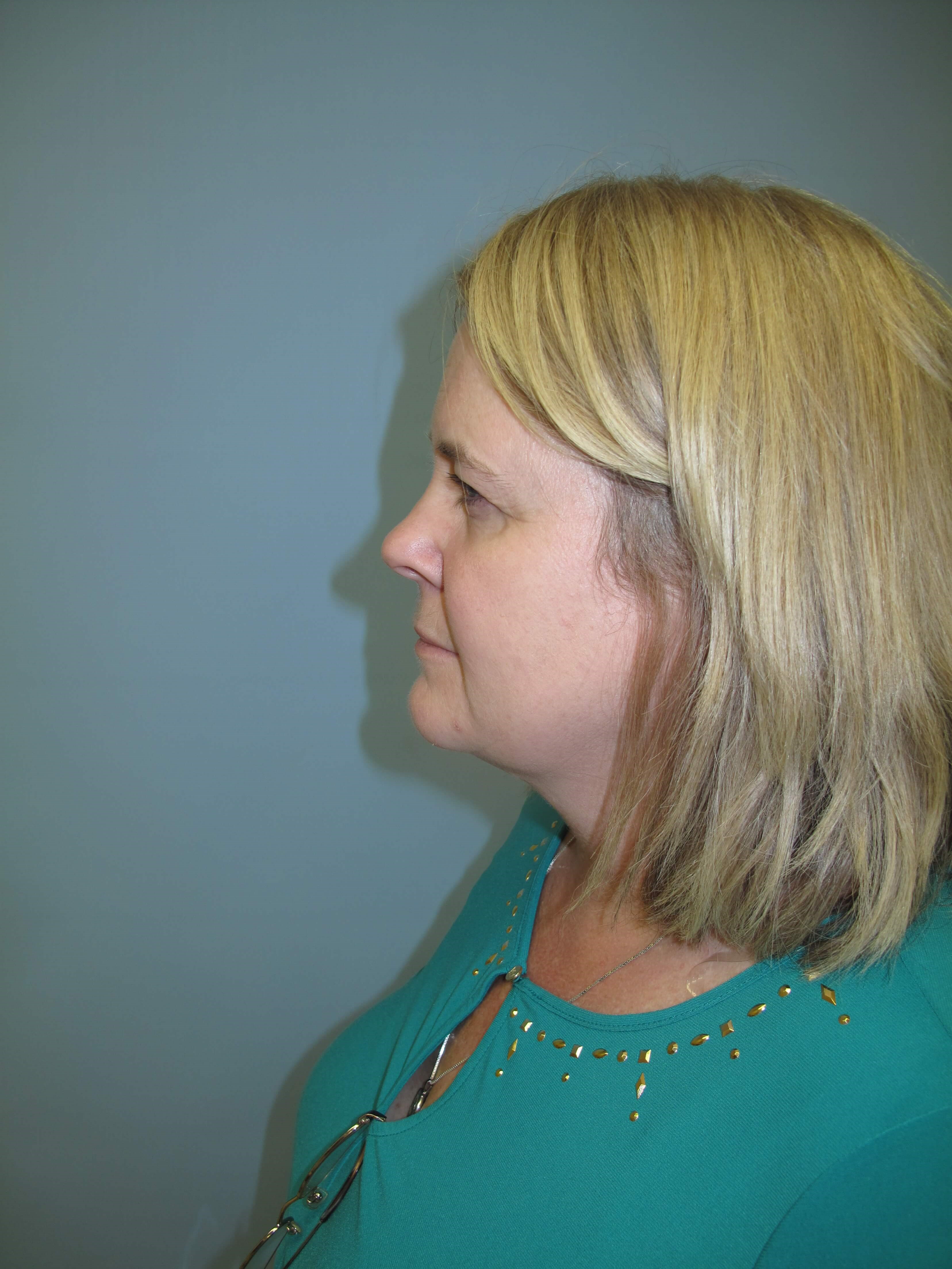 Upper eyelid blepharoplasty Before